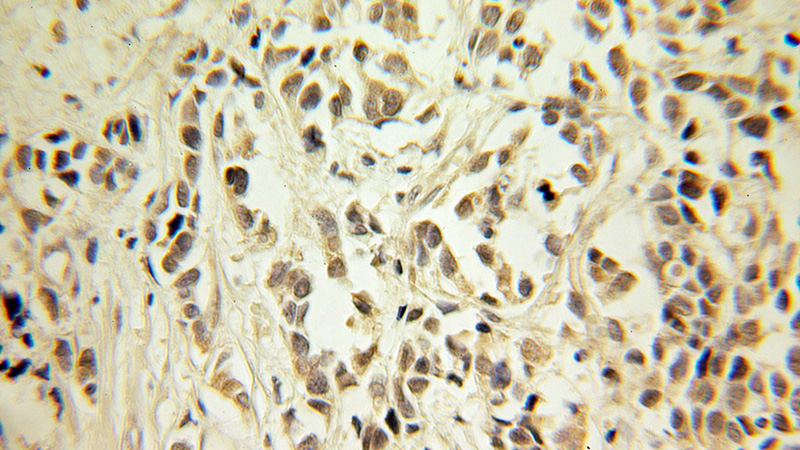 Immunohistochemical of paraffin-embedded human prostate cancer using Catalog No:109354(CNOT8 antibody) at dilution of 1:100 (under 10x lens)