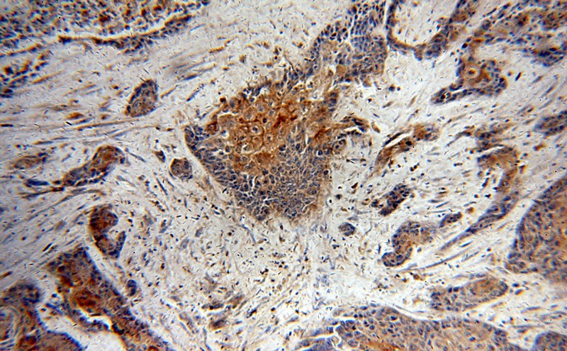 Immunohistochemical of paraffin-embedded human oesophagus cancer using Catalog No:112230(LIMS1 antibody) at dilution of 1:50 (under 10x lens)
