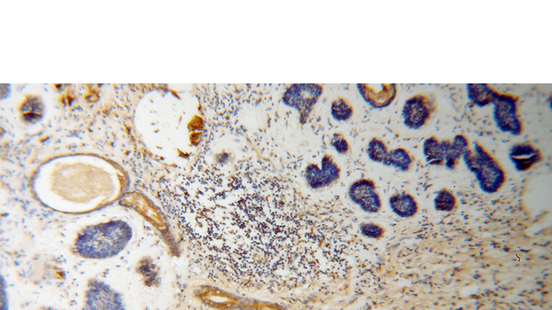 Immunohistochemical of paraffin-embedded human skin cancer using Catalog No:112651(MLPH antibody) at dilution of 1:50 (under 10x lens)