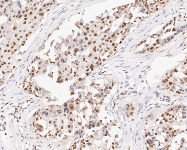 Fig6:; Immunohistochemical analysis of paraffin-embedded human breast carcinoma tissue using anti-GATAD2A antibody. The section was pre-treated using heat mediated antigen retrieval with sodium citrate buffer (pH 6.0) for 20 minutes. The tissues were blocked in 5% BSA for 30 minutes at room temperature, washed with ddH; 2; O and PBS, and then probed with the primary antibody ( 1/200) for 30 minutes at room temperature. The detection was performed using an HRP conjugated compact polymer system. DAB was used as the chromogen. Tissues were counterstained with hematoxylin and mounted with DPX.