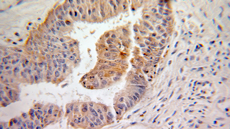 Immunohistochemical of paraffin-embedded human ovary tumor using Catalog No:110671(FKBP1A antibody) at dilution of 1:100 (under 25x lens)