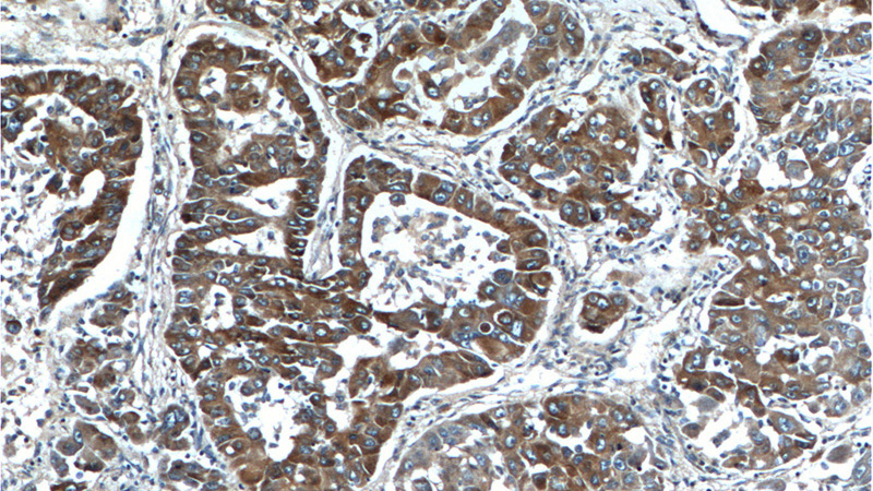 Immunohistochemistry of paraffin-embedded human liver cancer tissue slide using Catalog No:109728(CTPS Antibody) at dilution of 1:100 (under 10x lens).