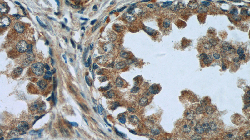 Immunohistochemistry of paraffin-embedded human prostate cancer tissue slide using Catalog No:112453(MAGEH1 Antibody) at dilution of 1:50 (under 40x lens)
