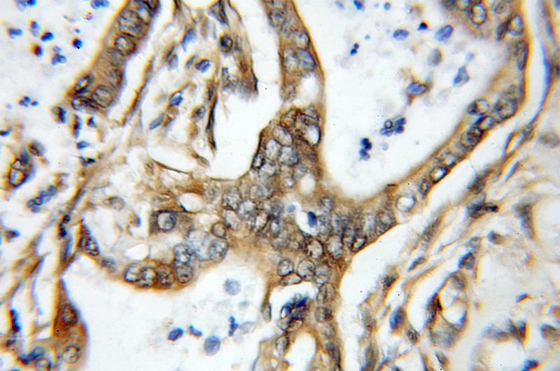 Immunohistochemical of paraffin-embedded human pancreas cancer using Catalog No:108144(ARL5B antibody) at dilution of 1:50 (under 10x lens)