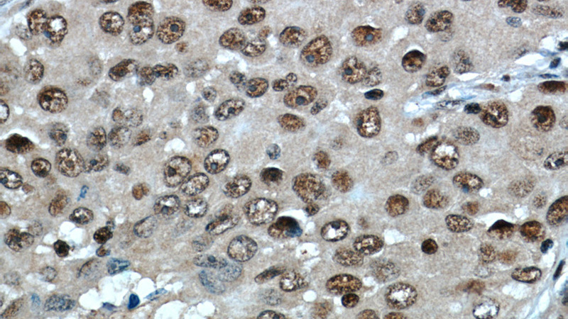 Immunohistochemistry of paraffin-embedded human lung cancer slide using Catalog No:116070(TLE3 Antibody) at dilution of 1:50