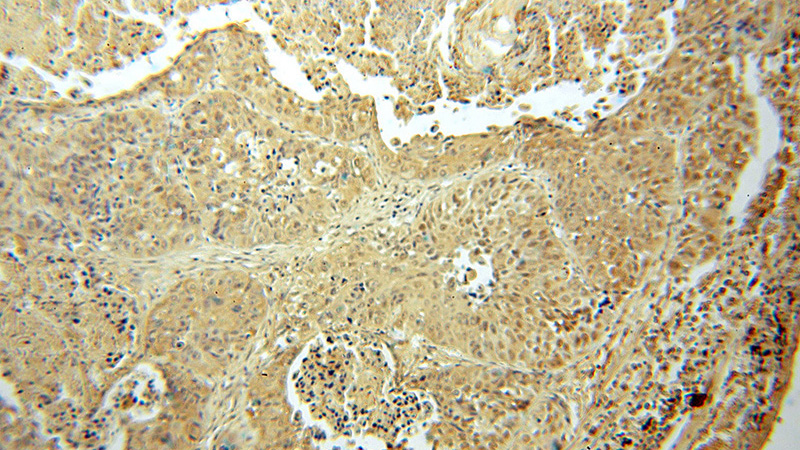 Immunohistochemical of paraffin-embedded human lung cancer using Catalog No:113861(PK-M2-specific antibody) at dilution of 1:100 (under 10x lens)