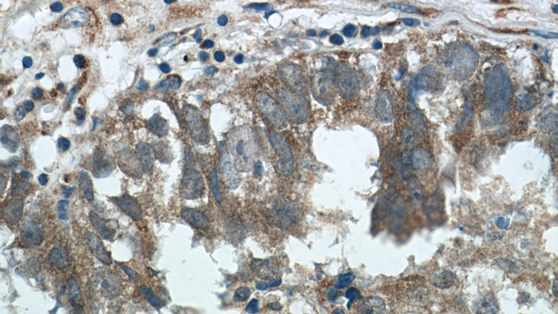 Immunohistochemistry of paraffin-embedded human breast cancer tissue slide using Catalog No:117040(ZFP36 Antibody) at dilution of 1:50 (under 40x lens)