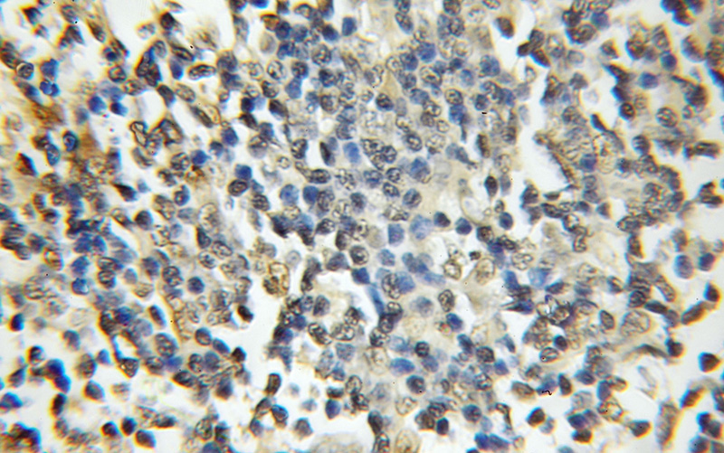 Immunohistochemical of paraffin-embedded human lymphoma using Catalog No:109779(DDX1 antibody) at dilution of 1:50 (under 10x lens)