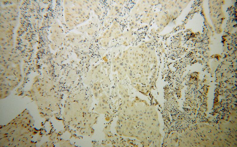 Immunohistochemical of paraffin-embedded human cervical cancer using Catalog No:115692(STAT5A antibody) at dilution of 1:100 (under 10x lens)