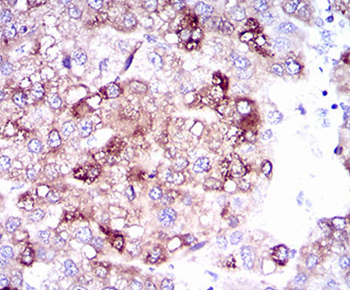 Fig4: Immunohistochemical analysis of paraffin-embedded human liver cancer tissue using anti-SLC27A5 antibody. Counter stained with hematoxylin.