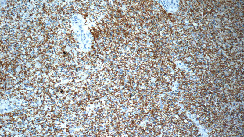 Immunohistochemistry of paraffin-embedded human gliomas slide using Catalog No:114775(ROBO3-Specific Antibody) at dilution of 1:50