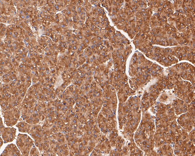 Fig2: Immunohistochemical analysis of paraffin-embedded human liver carcinoma tissue using anti-TRPML3 antibody. The section was pre-treated using heat mediated antigen retrieval with sodium citrate buffer (pH 6.0) for 20 minutes. The tissues were blocked in 5% BSA for 30 minutes at room temperature, washed with ddH2O and PBS, and then probed with the primary antibody ( 1/50) for 30 minutes at room temperature. The detection was performed using an HRP conjugated compact polymer system. DAB was used as the chromogen. Tissues were counterstained with hematoxylin and mounted with DPX.