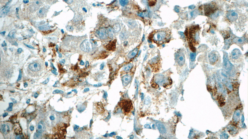 Immunohistochemistry of paraffin-embedded human liver cancer tissue slide using Catalog No:114897(RPL5 Antibody) at dilution of 1:50 (under 40x lens)