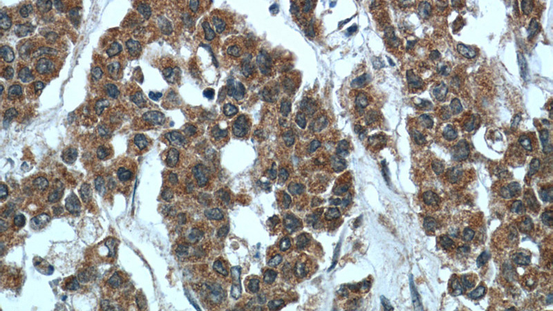 Immunohistochemistry of paraffin-embedded human colon cancer tissue slide using Catalog No:108737(C5orf4 Antibody) at dilution of 1:50 (under 40x lens)