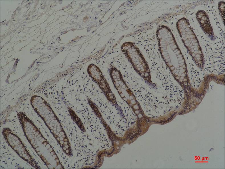 Immunohistochemical analysis of paraffin-embedded Human Colon Caricnoma using HSP90 alpha;  Mouse mAb diluted at 1:200.