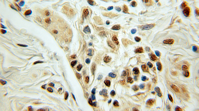 Immunohistochemical of paraffin-embedded human ovary tumor using Catalog No:113355(NUDT11 antibody) at dilution of 1:100 (under 10x lens)