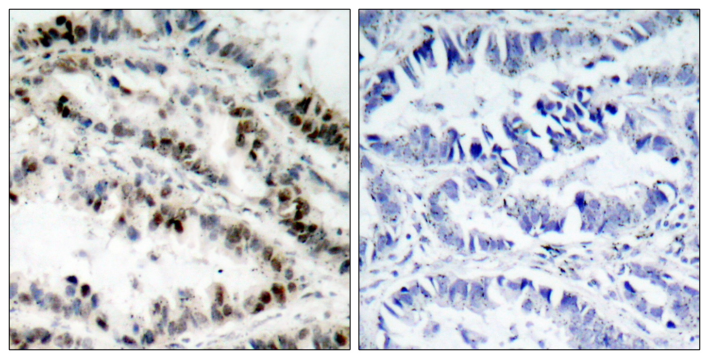 Immunohistochemical analysis of paraffin-embedded human lung carcinoma tissue using SMC1 (Phospho-Ser957) Antibody  (left) or the same antibody preincubated with blocking peptide (right).