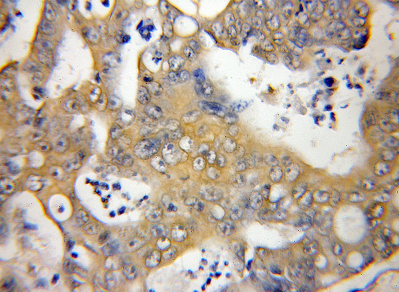 Immunohistochemical of paraffin-embedded human colon cancer using Catalog No:115413(SLU7 antibody) at dilution of 1:50 (under 10x lens)