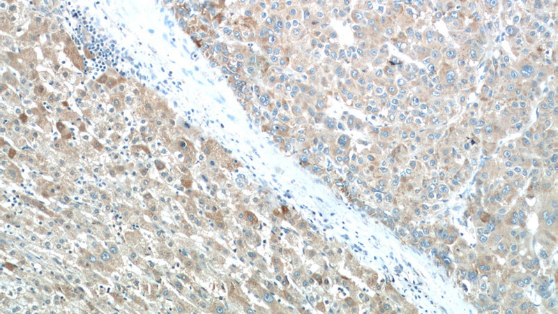 Immunohistochemistry of paraffin-embedded human liver cancer tissue slide using Catalog No:113677(PDGFRL Antibody) at dilution of 1:50 (under 10x lens)
