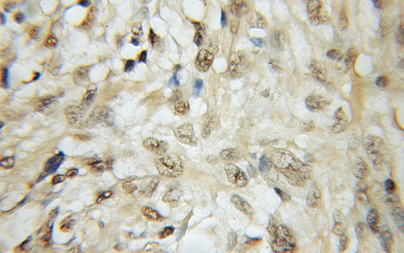 Immunohistochemical of paraffin-embedded human gliomas using Catalog No:115817(SUB1 antibody) at dilution of 1:50 (under 10x lens)