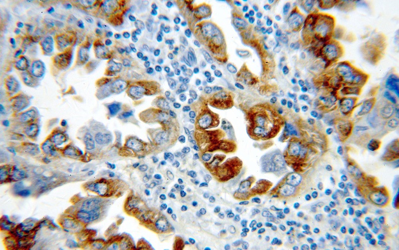 Immunohistochemical of paraffin-embedded human lung cancer using Catalog No:115158(SFTPC antibody) at dilution of 1:50 (under 40x lens)