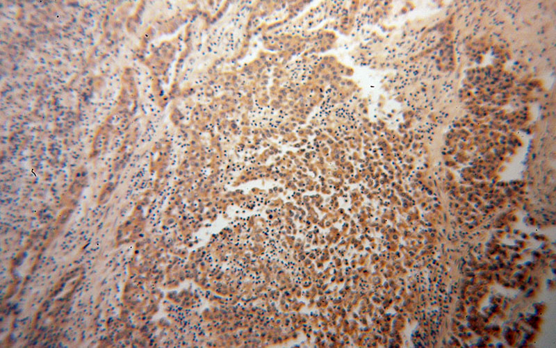Immunohistochemical of paraffin-embedded human pancreas cancer using Catalog No:107477(PLOD3 antibody) at dilution of 1:100 (under 10x lens)