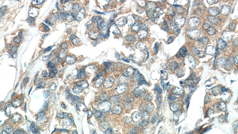 Immunohistochemistry of paraffin-embedded human breast cancer tissue slide using Catalog No:116821(WFDC1 Antibody) at dilution of 1:50 (under 40x lens)