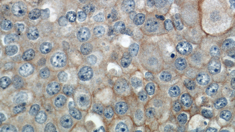 Immunohistochemical of paraffin-embedded human breast cancer using Catalog No:111076(SLC2A1,GLUT1 antibody) at dilution of 1:50 (under 40x lens)