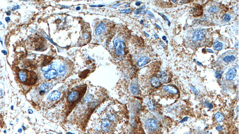 Immunohistochemistry of paraffin-embedded human liver cancer tissue slide using Catalog No:117116(BEND3 Antibody) at dilution of 1:200 (under 40x lens).