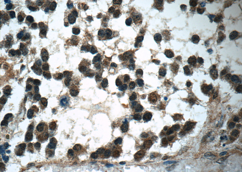 Immunohistochemistry of paraffin-embedded human gliomas tissue slide using Catalog No:113584(PARK7,DJ-1 Antibody) at dilution of 1:50 (under 40x lens)