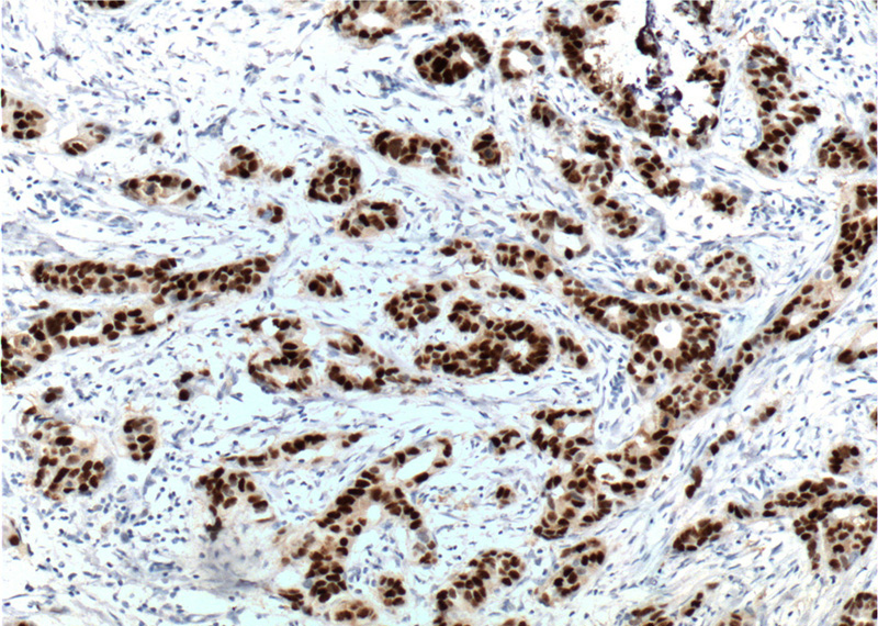 Immunohistochemistry of paraffin-embedded human breast cancer tissue slide using (PR Antibody) at dilution of 1:3200 (under 10x lens). heat mediated antigen retrieved with Tris-EDTA buffer(pH9).