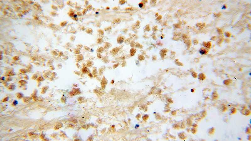 Immunohistochemical of paraffin-embedded human lung cancer using Catalog No:109999(DLX3 antibody) at dilution of 1:100 (under 40x lens)