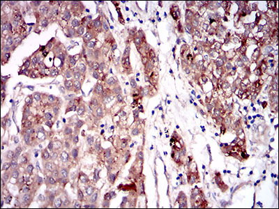 Fig4: Immunohistochemical analysis of paraffin-embedded human liver cancer tissue using anti-SERPINA7 antibody. Counter stained with hematoxylin.
