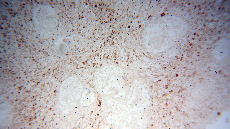 Immunohistochemical of paraffin-embedded human osteosarcoma using Catalog No:116732(VDAC3 antibody) at dilution of 1:100 (under 10x lens)