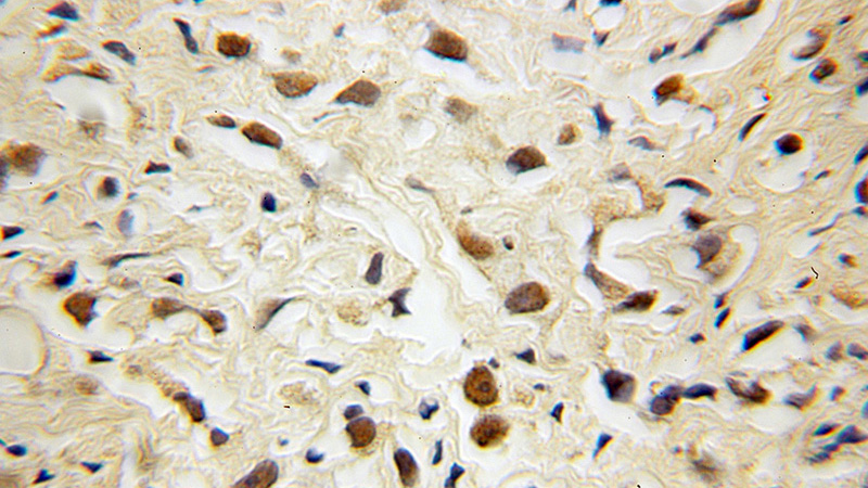 Immunohistochemical of paraffin-embedded human gliomas using Catalog No:109746(CUL4B antibody) at dilution of 1:100 (under 10x lens)