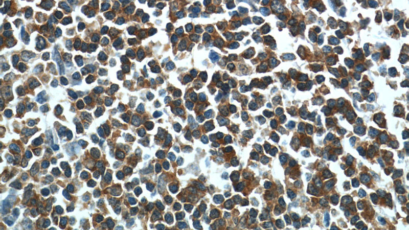 Immunohistochemistry of paraffin-embedded human tonsillitis tissue slide using Catalog No:111283(HCLS1 Antibody) at dilution of 1:50 (under 40x lens)