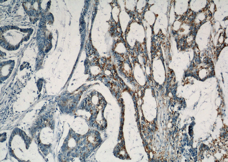 Immunohistochemical of paraffin-embedded human colon cancer using Catalog No:108393(B4GALT2 antibody) at dilution of 1:100 (under 10x lens)