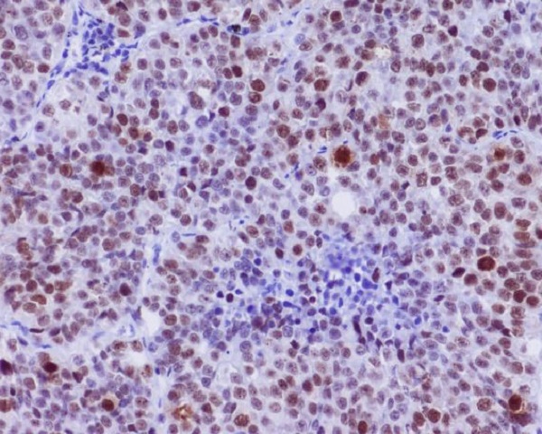 Immunohistochemical analysis of paraffin-embedded human lung carcinoma, using Phospho-c-Myc (S62) Antibody .