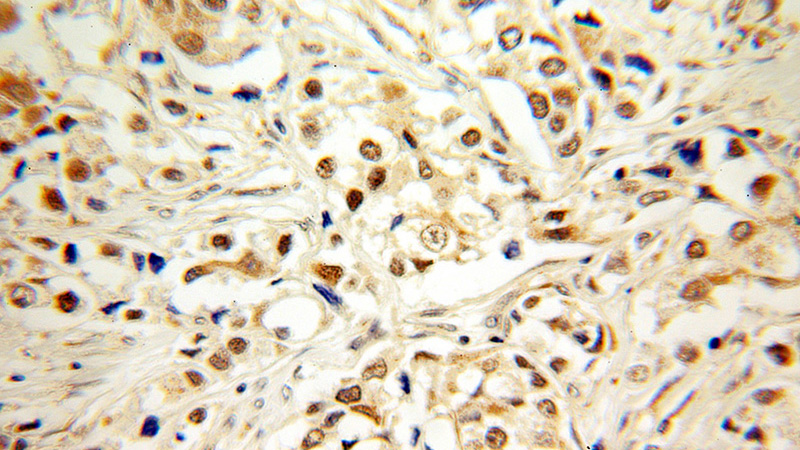 Immunohistochemical of paraffin-embedded human breast cancer using Catalog No:109667(CCNG1 antibody) at dilution of 1:100 (under 10x lens)
