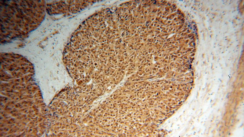 Immunohistochemical of paraffin-embedded human liver cancer using Catalog No:113770(PFKFB3 antibody) at dilution of 1:100 (under 10x lens)
