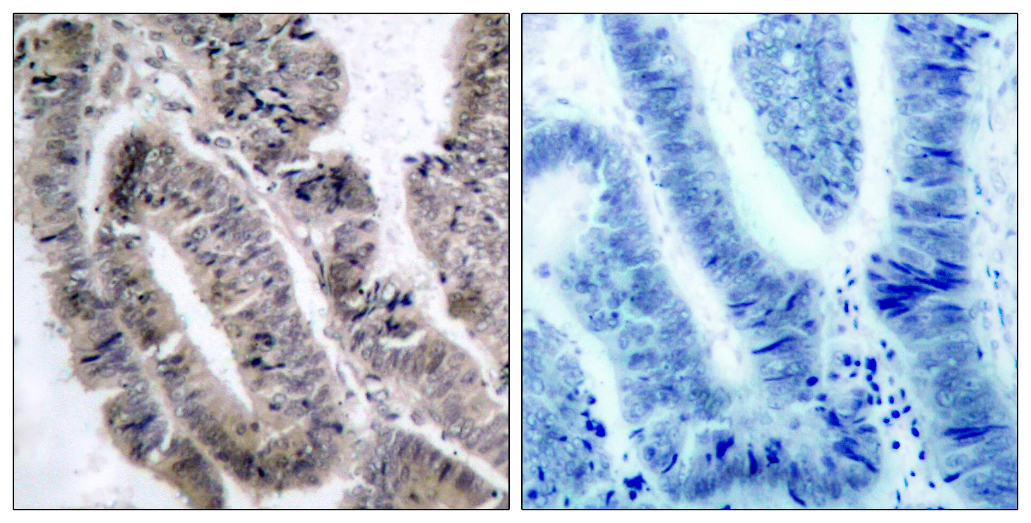 Immunohistochemical analysis of paraffin-embedded human colon carcinoma tissue using AMPKu03b11 (Phospho-Ser487)Antibody  (left) or the same antibody preincubated with blocking peptide (right).