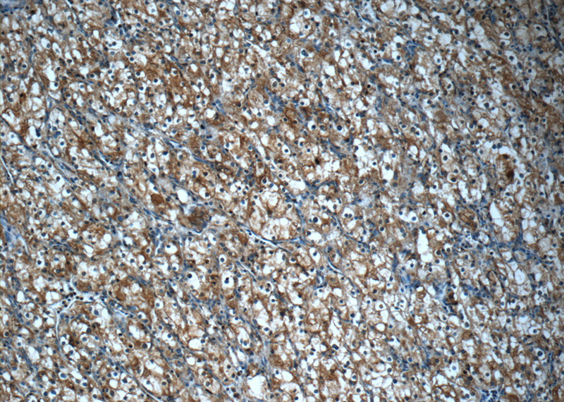Immunohistochemistry of paraffin-embedded human renal cell carcinoma tissue slide using Catalog No:110510(FAM92A1 Antibody) at dilution of 1:50 (under 10x lens)
