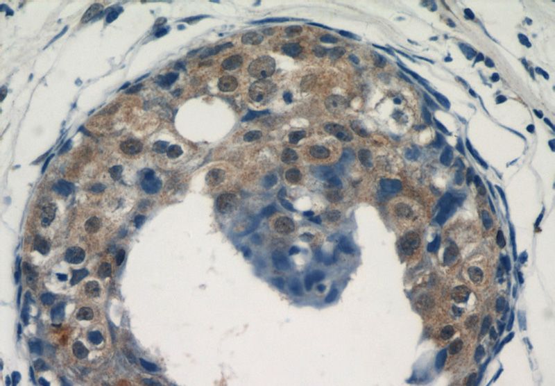Immunohistochemical of paraffin-embedded human breast cancer using Catalog No:107740(ACK1 antibody) at dilution of 1:50 (under 40x lens)