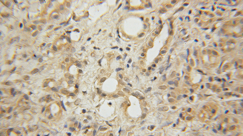Immunohistochemical of paraffin-embedded human pancreas cancer using Catalog No:111086(GLYCTK antibody) at dilution of 1:50 (under 10x lens)