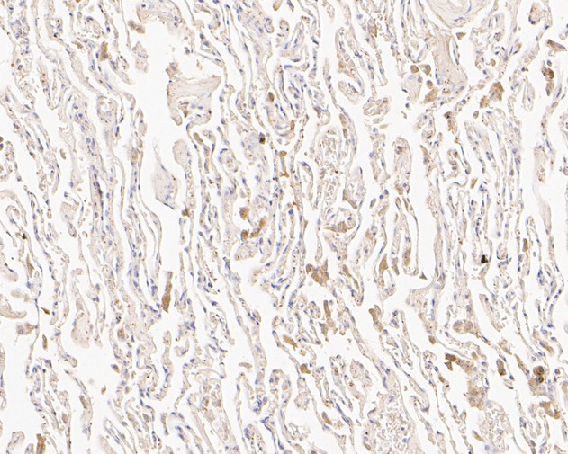 Fig2:; Immunohistochemical analysis of paraffin-embedded human lung tissue using anti-SLFN12 antibody. The section was pre-treated using heat mediated antigen retrieval with Tris-EDTA buffer (pH 8.0-8.4) for 20 minutes.The tissues were blocked in 5% BSA for 30 minutes at room temperature, washed with ddH; 2; O and PBS, and then probed with the primary antibody ( 1/200) for 30 minutes at room temperature. The detection was performed using an HRP conjugated compact polymer system. DAB was used as the chromogen. Tissues were counterstained with hematoxylin and mounted with DPX.