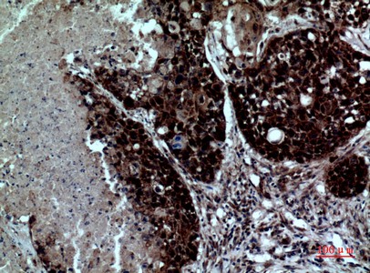 Fig2:; Immunohistochemical analysis of paraffin-embedded human-lung, antibody was diluted at 1:100