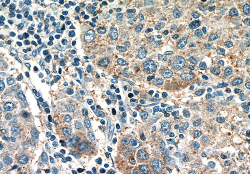 Immunohistochemistry of paraffin-embedded human liver cancer slide using Catalog No:108736(C5orf26 Antibody) at dilution of 1:50 (under 40x lens)