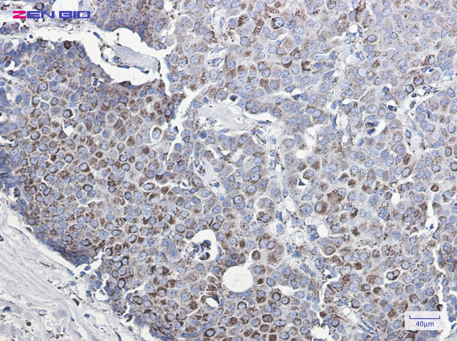 Immunohistochemistry of MMP3 in paraffin-embedded Human breast cancer tissue using MMP3 Rabbit pAb at dilution 1/20