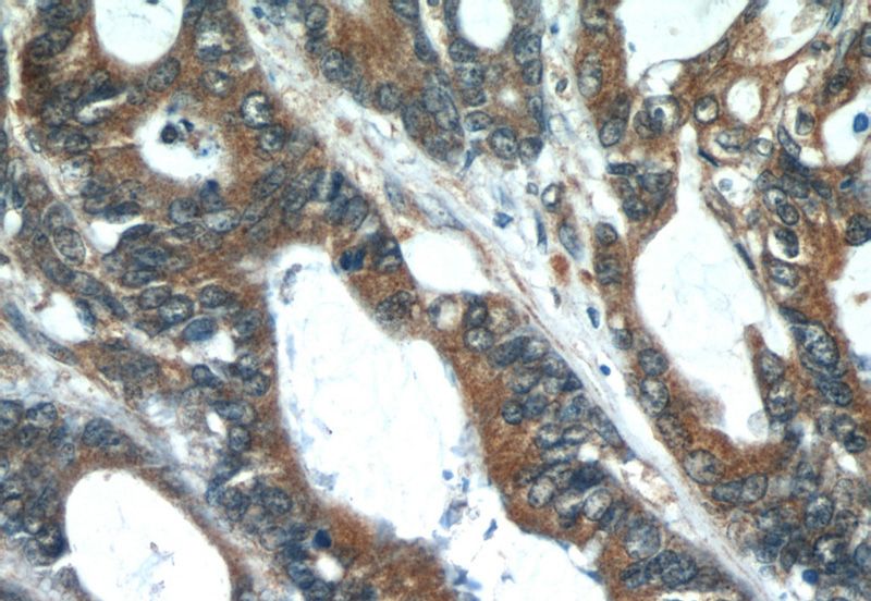 Immunohistochemical of paraffin-embedded human colon cancer using Catalog No:113754(PCSK9 antibody) at dilution of 1:50 (under 40x lens)