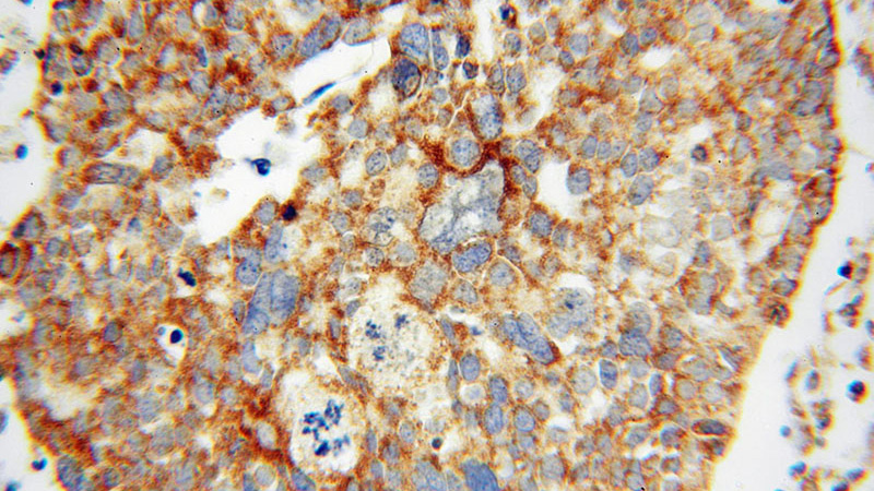 Immunohistochemical of paraffin-embedded human ovary tumor using Catalog No:112828(MRPL44 antibody) at dilution of 1:50 (under 40x lens)